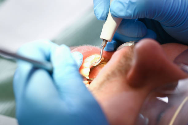 Best Emergency Dentist for Lost Fillings or Crowns in Prospect, OH
